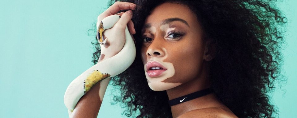 winne harlow, la modella famosa per la sua vitiligine